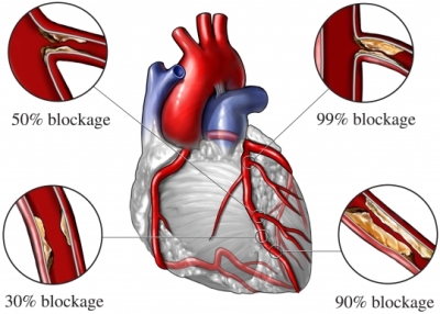 dyslipidemia