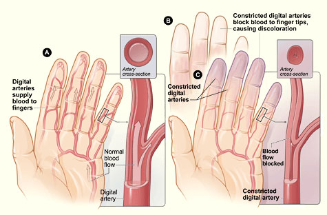 Παθοφυσιολογία του φαινομένου Raynaud